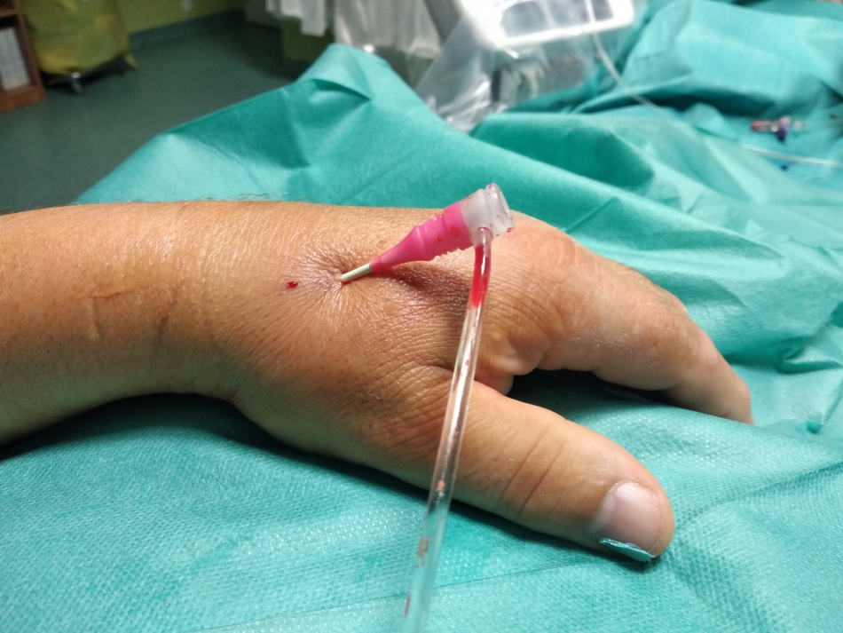 Kardiologové v Plzni provedli jako první v republice výkon přes přístup u palce ruky