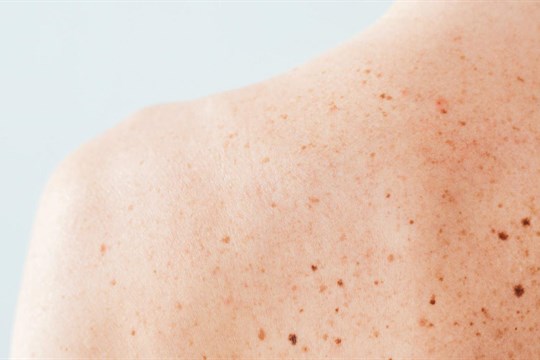 Kožní nádory trápí už i třicátníky, víte, jak jim zabránit?